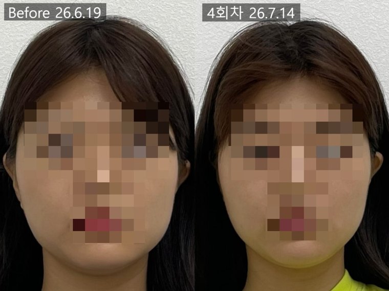 one-sided-jaw-asymmetry 치료 사례 9 — 시술 전후 비교