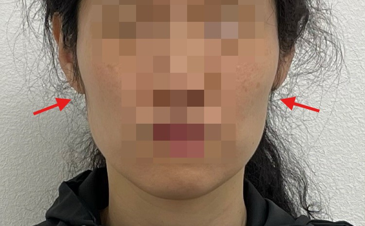 얼굴형 시술 기록 1 — 동일 인물·동일 조건에서 촬영한 보정 없는 원본 사진