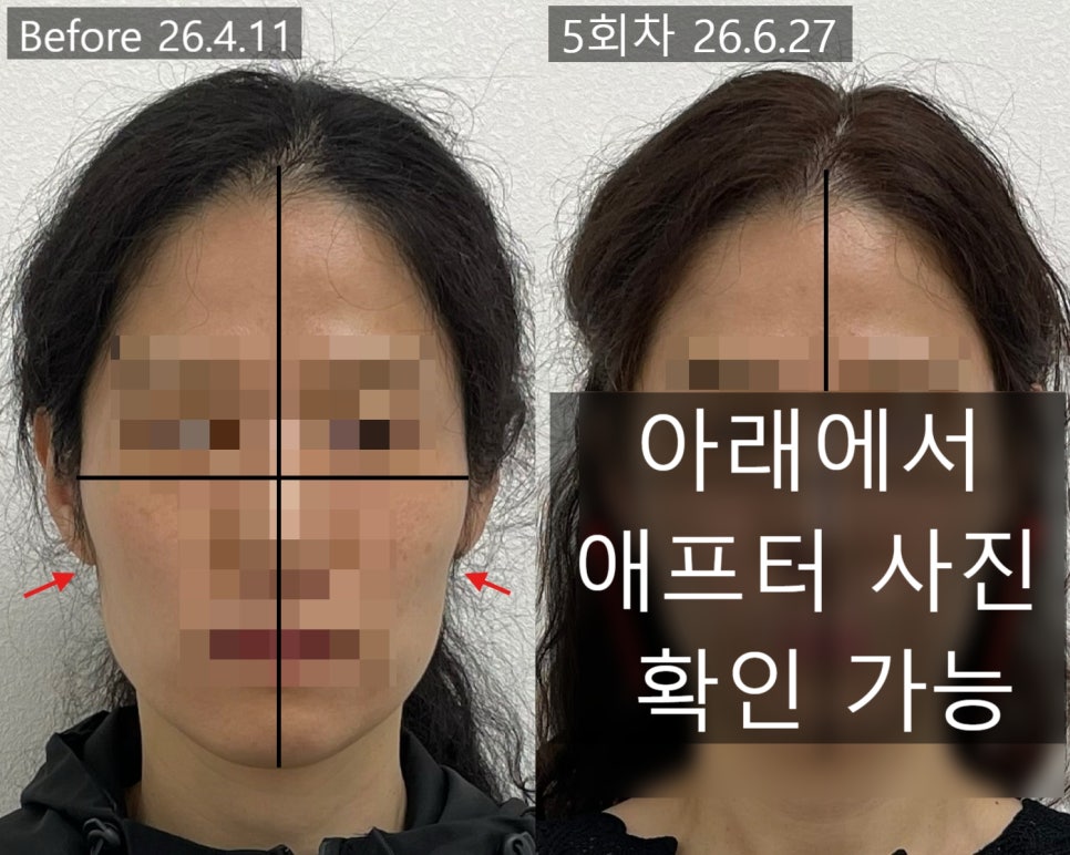 얼굴형 시술 기록 2 — 동일 인물·동일 조건에서 촬영한 보정 없는 원본 사진