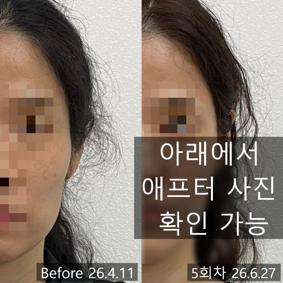 얼굴형 시술 기록 3 — 동일 인물·동일 조건에서 촬영한 보정 없는 원본 사진