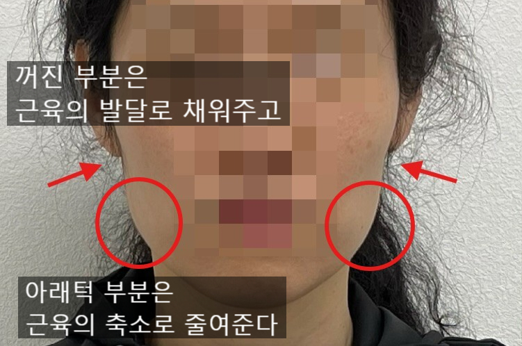 얼굴형 시술 기록 4 — 동일 인물·동일 조건에서 촬영한 보정 없는 원본 사진