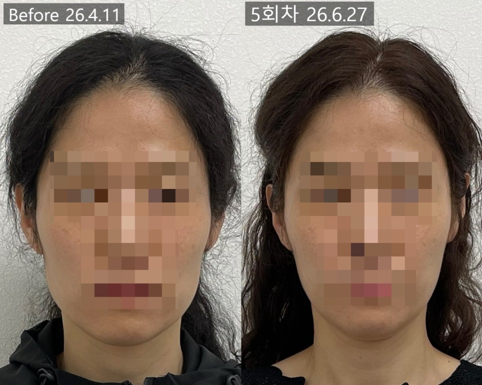 얼굴형 시술 기록 6 — 동일 인물·동일 조건에서 촬영한 보정 없는 원본 사진