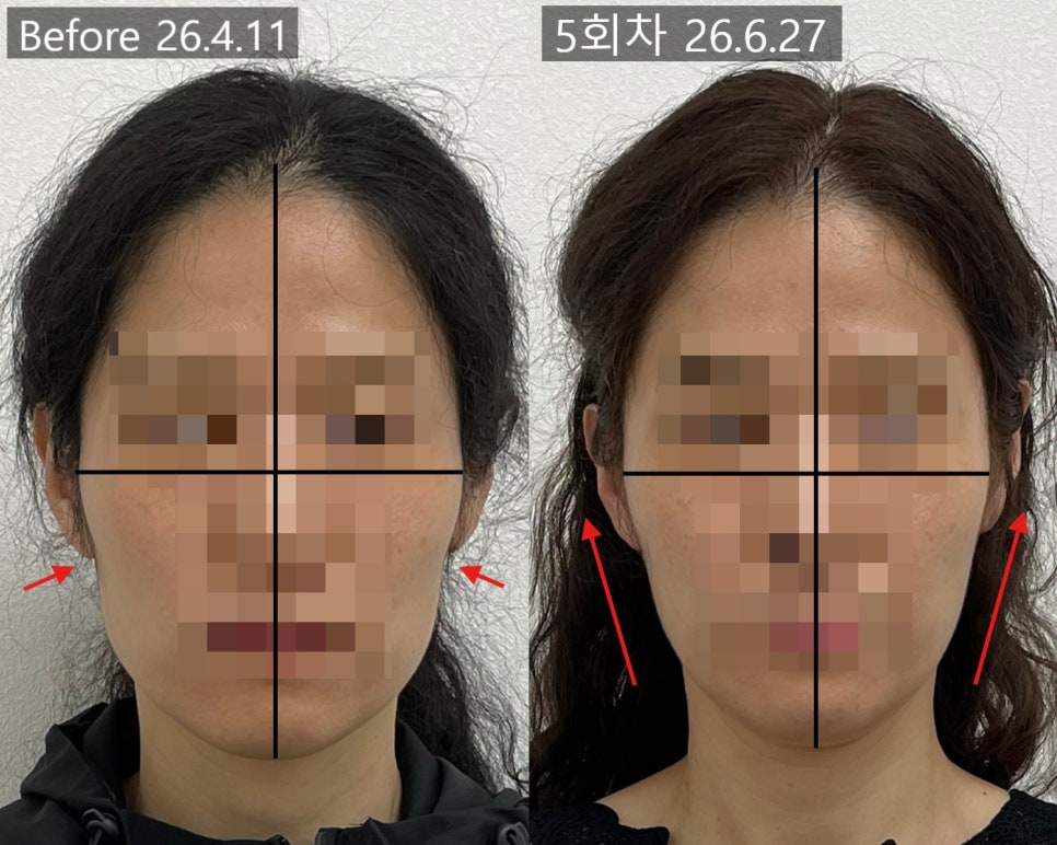 얼굴형 시술 기록 7 — 동일 인물·동일 조건에서 촬영한 보정 없는 원본 사진