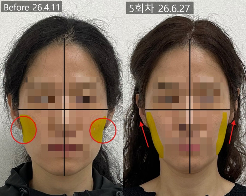 얼굴형 시술 기록 8 — 동일 인물·동일 조건에서 촬영한 보정 없는 원본 사진