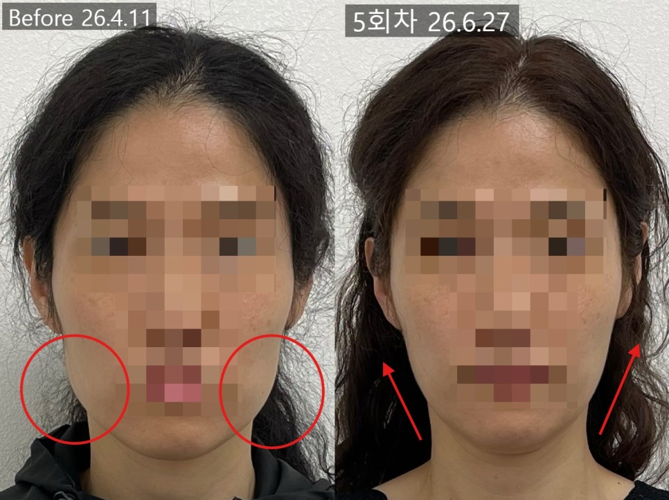 얼굴형 시술 기록 9 — 동일 인물·동일 조건에서 촬영한 보정 없는 원본 사진