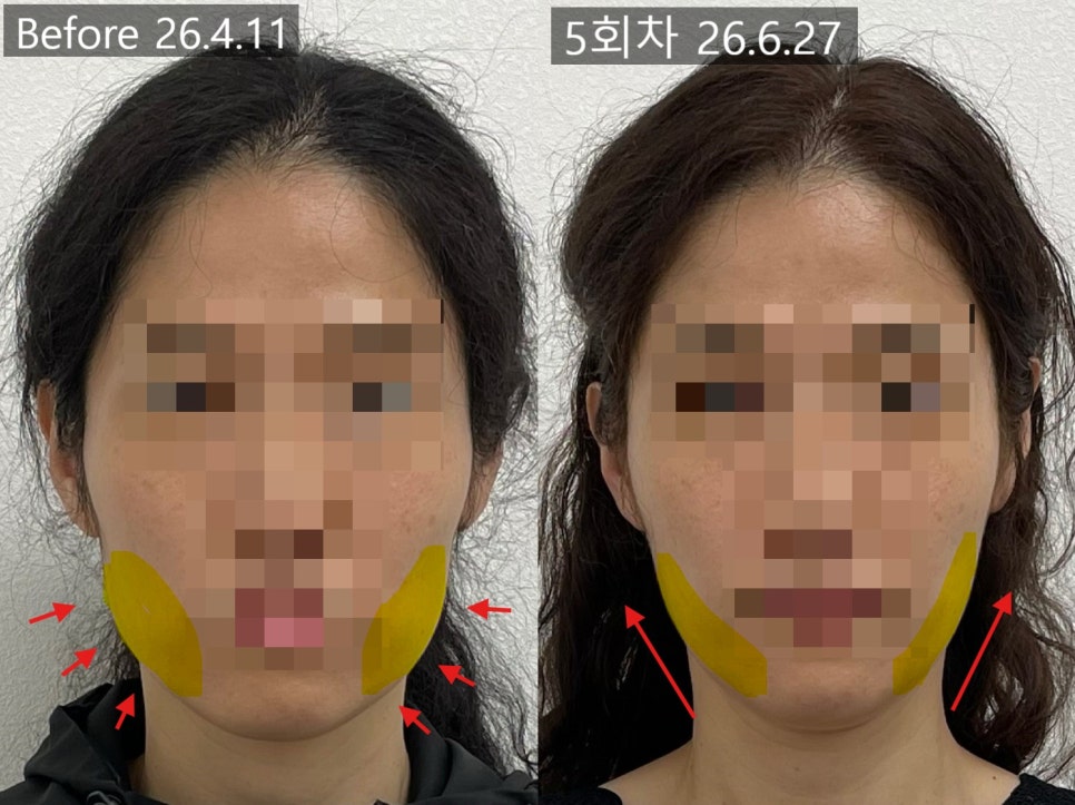 얼굴형 시술 기록 10 — 동일 인물·동일 조건에서 촬영한 보정 없는 원본 사진