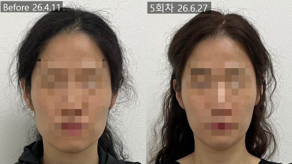 얼굴형 시술 기록 11 — 동일 인물·동일 조건에서 촬영한 보정 없는 원본 사진