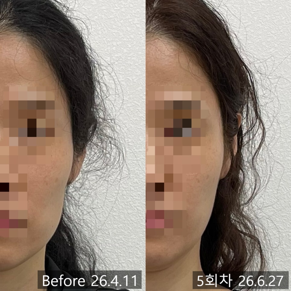 얼굴형 시술 기록 12 — 동일 인물·동일 조건에서 촬영한 보정 없는 원본 사진