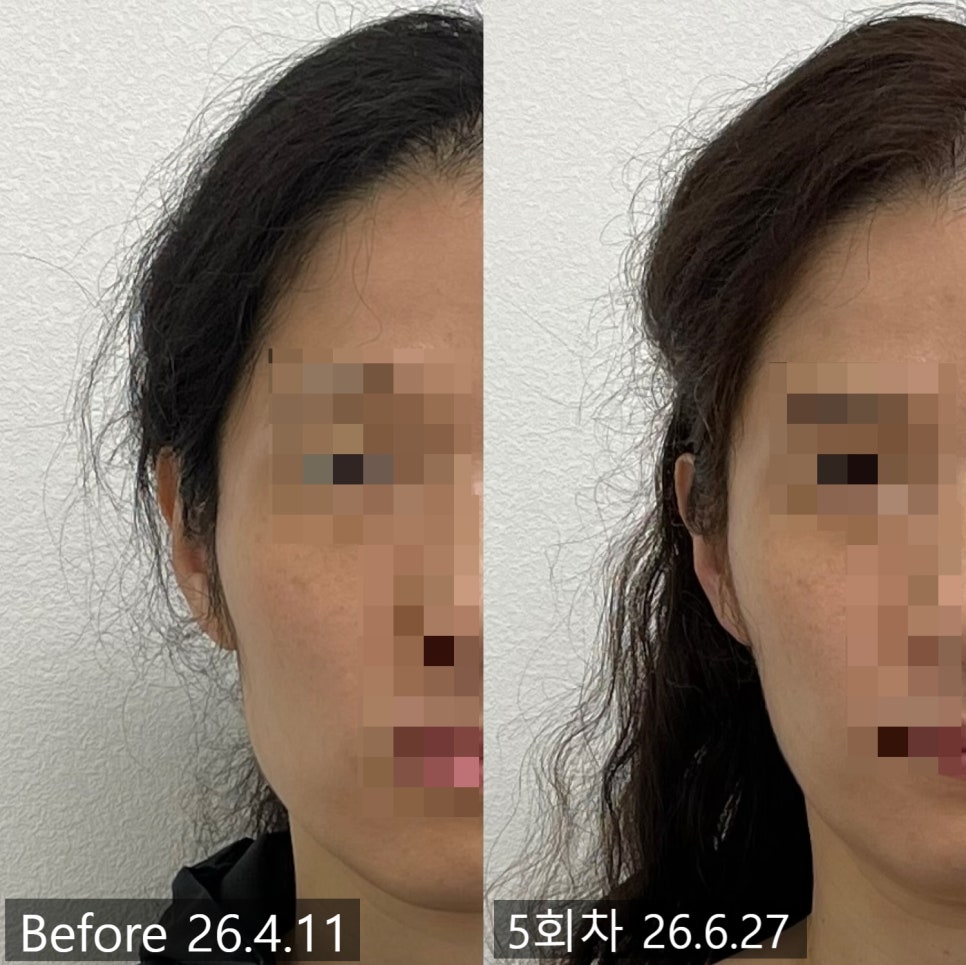 얼굴형 시술 기록 13 — 동일 인물·동일 조건에서 촬영한 보정 없는 원본 사진
