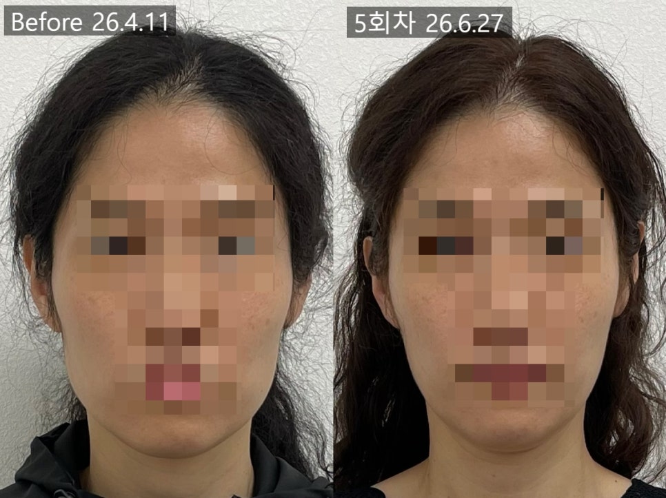 얼굴형 시술 기록 14 — 동일 인물·동일 조건에서 촬영한 보정 없는 원본 사진