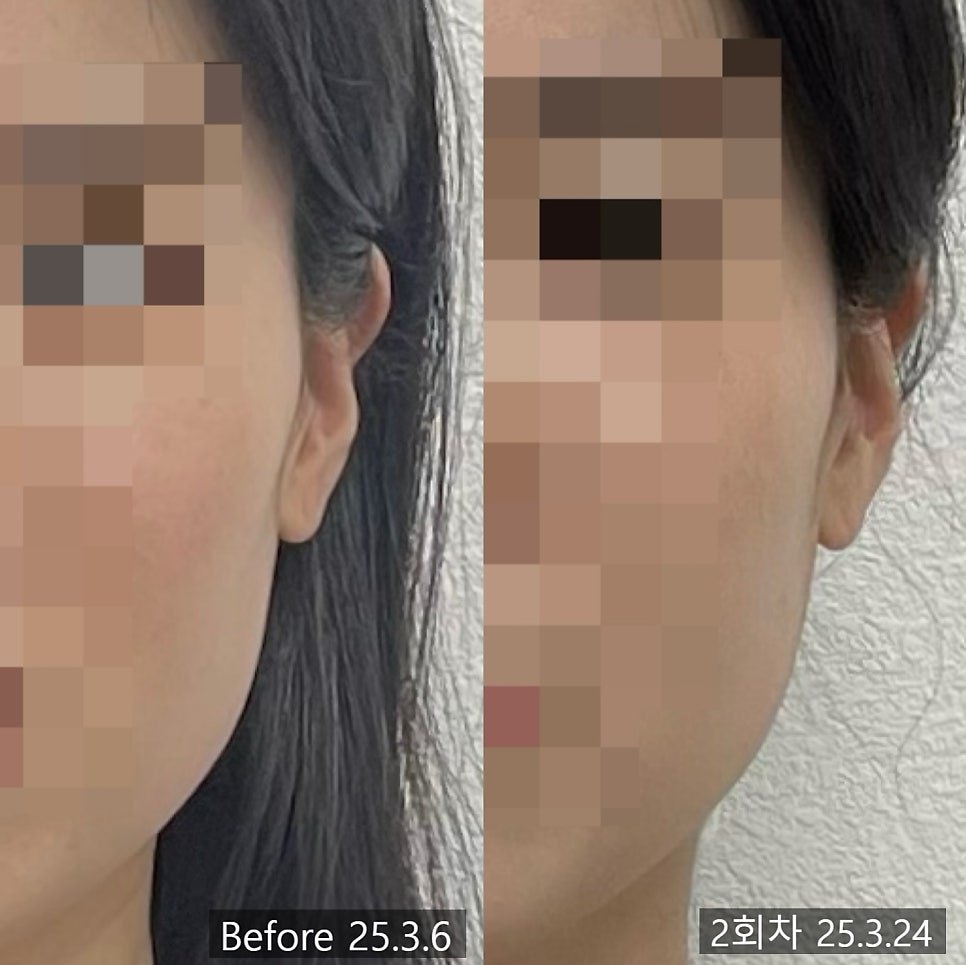 자연산 윤곽침 2회차 측면 전후 비교 — 동일 인물·동일 조건에서 촬영한 보정 없는 원본