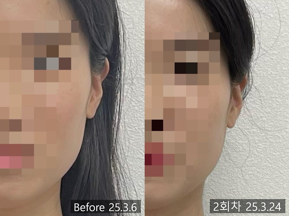 비스듬한 각도에서 촬영한 2회차 전후 비교 — 보정 없는 원본