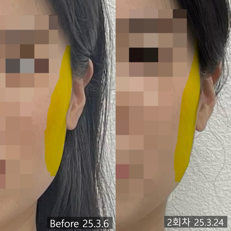 옆볼 구역을 노란색으로 표시한 2회차 전후 비교 — 보정 없는 원본