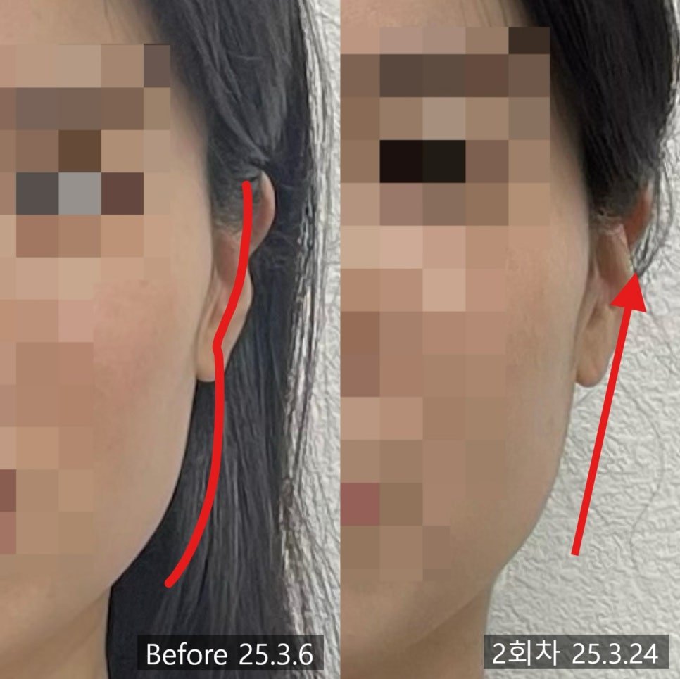 얼굴 옆선 라인과 방향 화살표를 얹은 2회차 전후 비교 — 보정 없는 원본