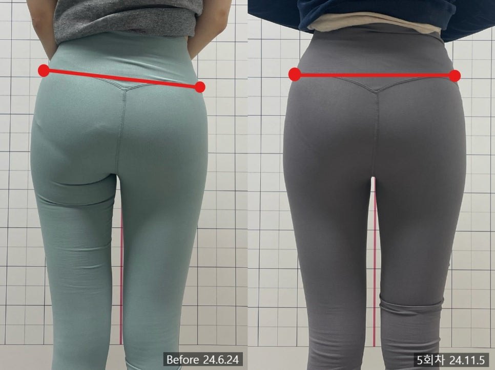 좌우 골반 높이에 수평 기준선을 얹은 5회차 후면 전후 비교 — 보정 없는 원본