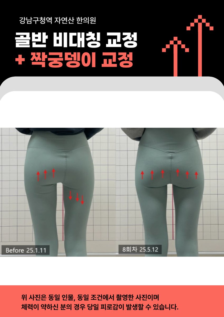 다른 분의 8회차 후면 전후 비교와 고지문구 배너 — 보정 없는 원본