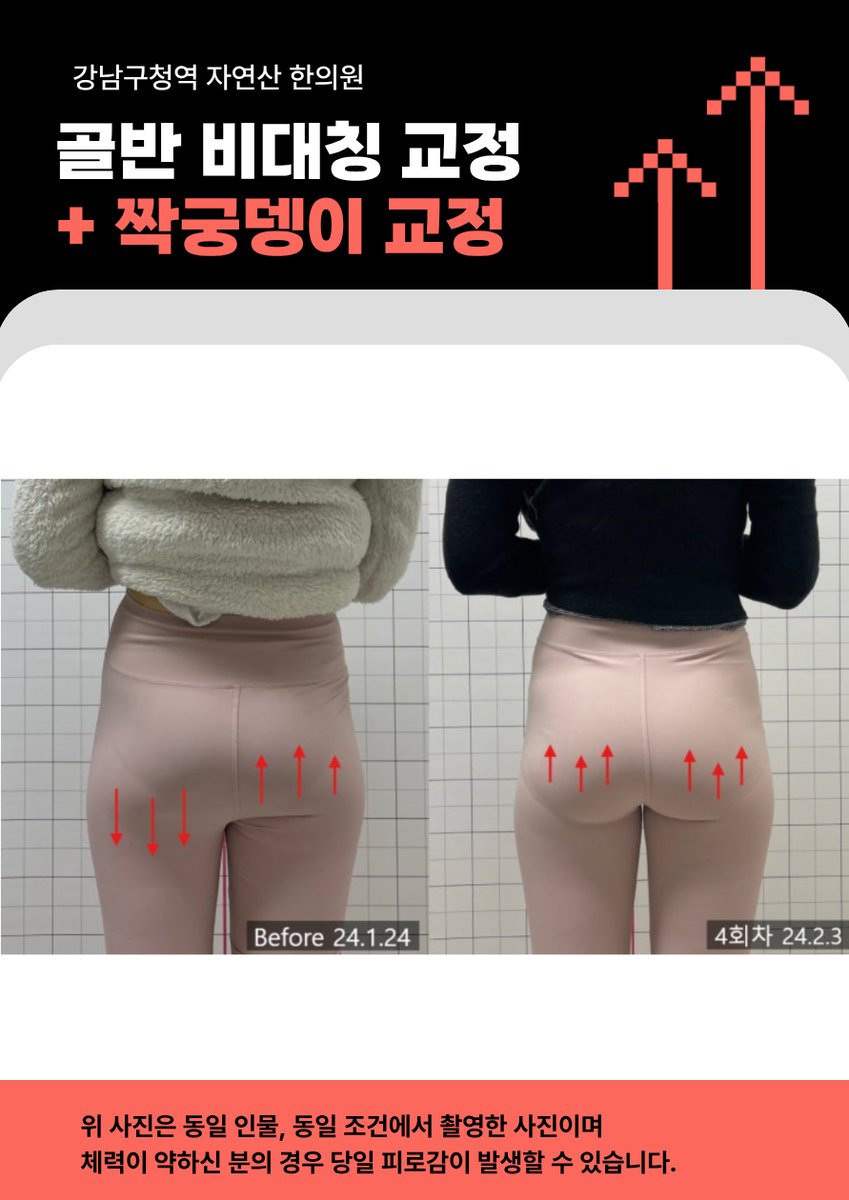 또 다른 분의 4회차 후면 전후 비교와 고지문구 배너 — 보정 없는 원본