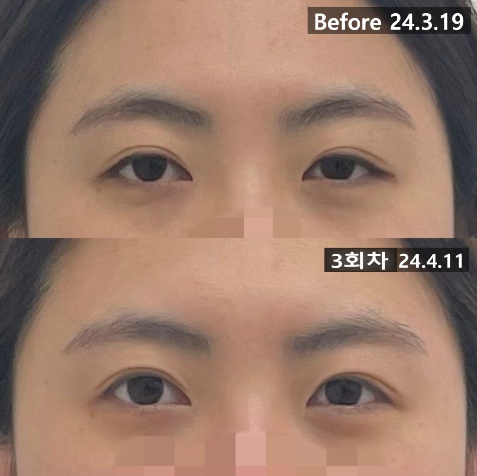 눈 부위를 확대해 위아래로 배치한 3회차 전후 비교 — 동일 인물·동일 조건에서 촬영한 보정 없는 원본