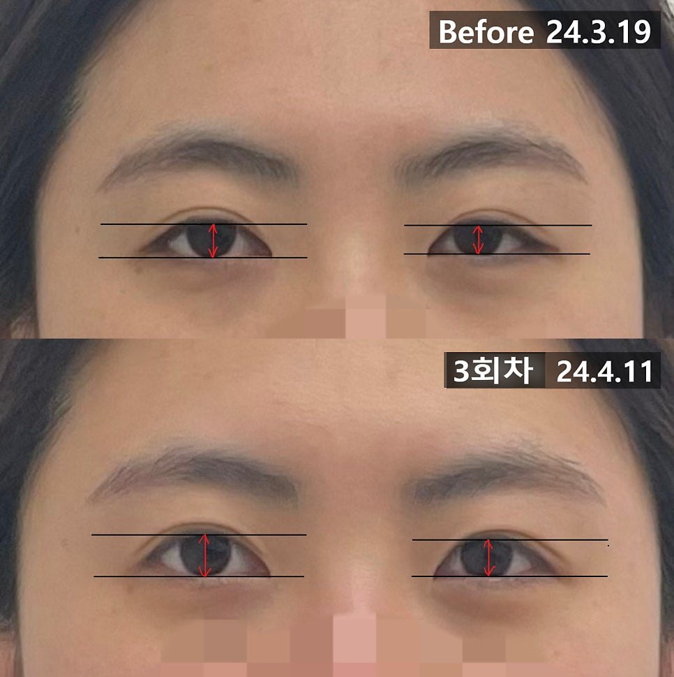 좌우 눈 높이에 수평 기준선을 얹어 확대한 3회차 전후 비교 — 보정 없는 원본