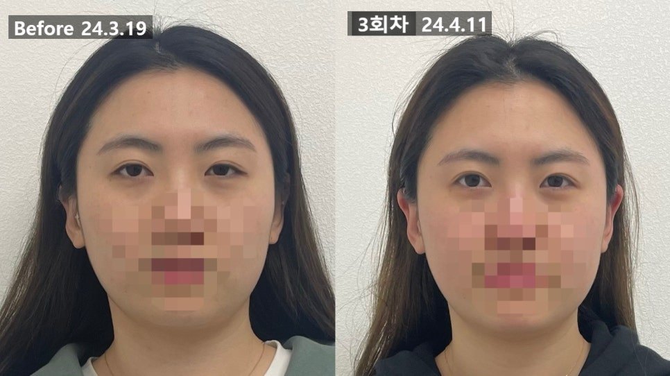 정면 얼굴 전체를 나란히 둔 3회차 전후 비교 — 보정 없는 원본