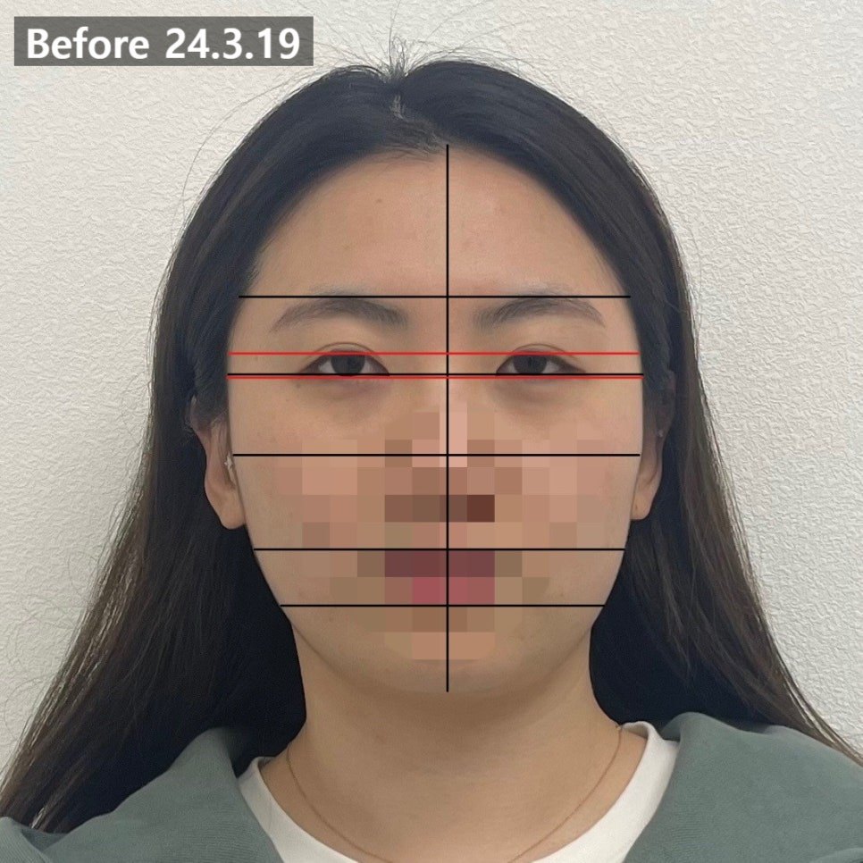 치료 전 정면 사진에 격자 기준선을 얹어 좌우 눈 위치를 표시한 컷 — 보정 없는 원본