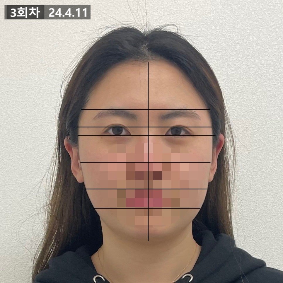 3회차 정면 사진에 같은 격자 기준선을 얹어 좌우 눈 위치를 표시한 컷 — 보정 없는 원본
