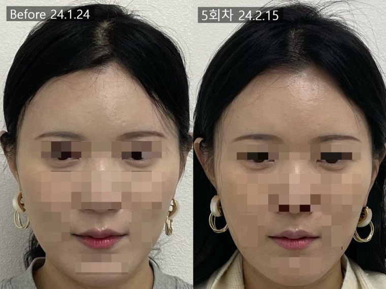 short-midface 치료 사례 1 — 시술 전후 비교