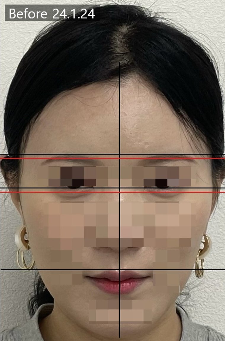 short-midface 치료 사례 3 — 시술 전후 비교