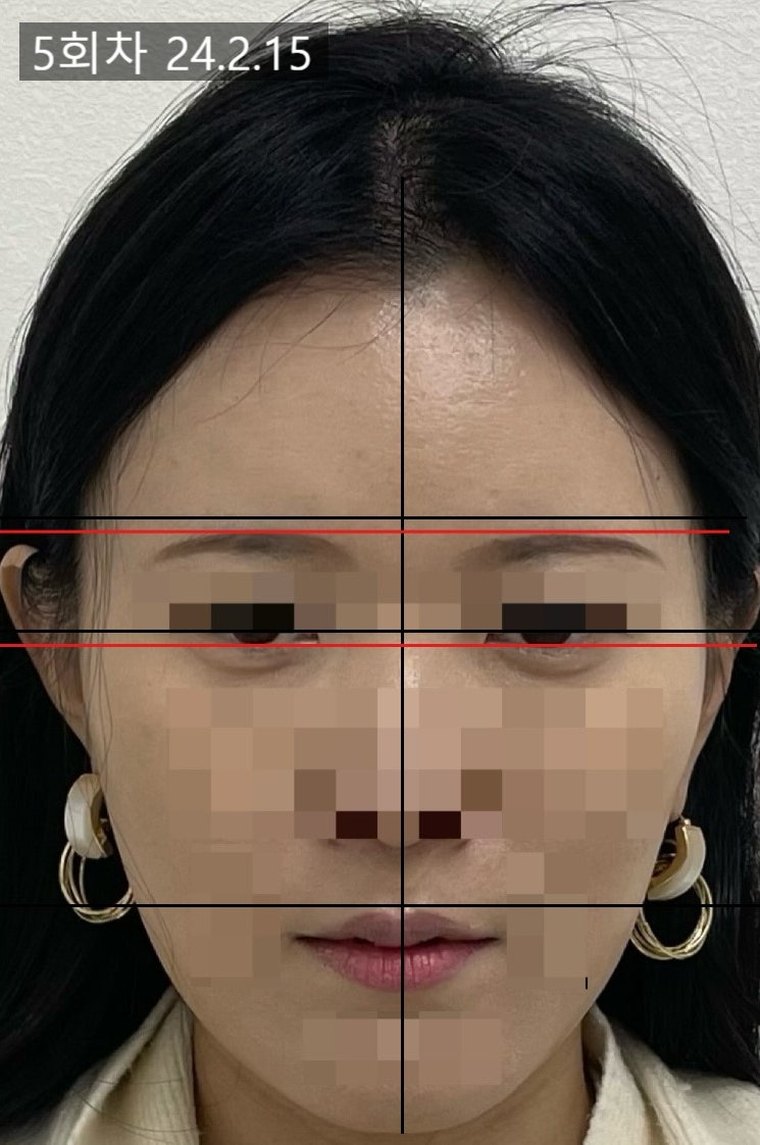 short-midface 치료 사례 4 — 시술 전후 비교