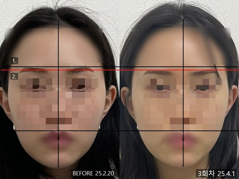shorter-face-method 치료 사례 1 — 시술 전후 비교
