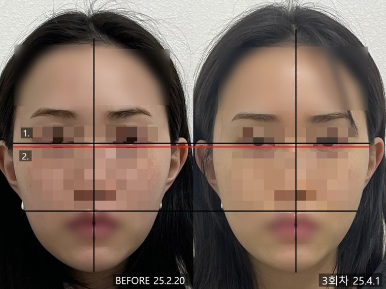 shorter-face-method 치료 사례 2 — 시술 전후 비교