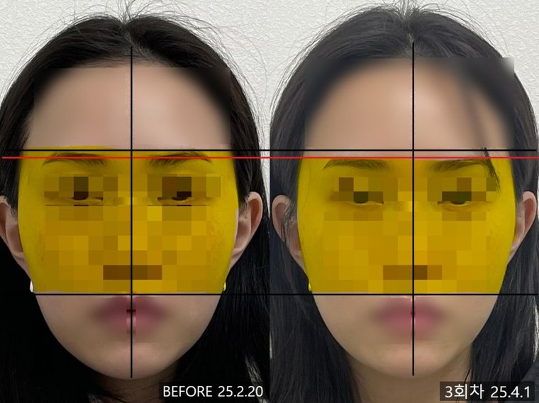 shorter-face-method 치료 사례 3 — 시술 전후 비교