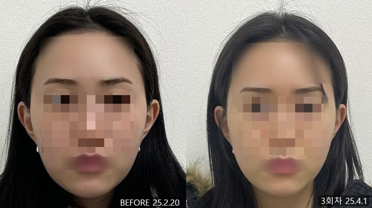 shorter-face-method 치료 사례 4 — 시술 전후 비교