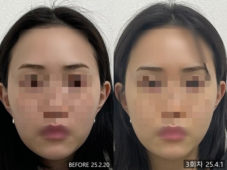 shorter-face-method 치료 사례 5 — 시술 전후 비교