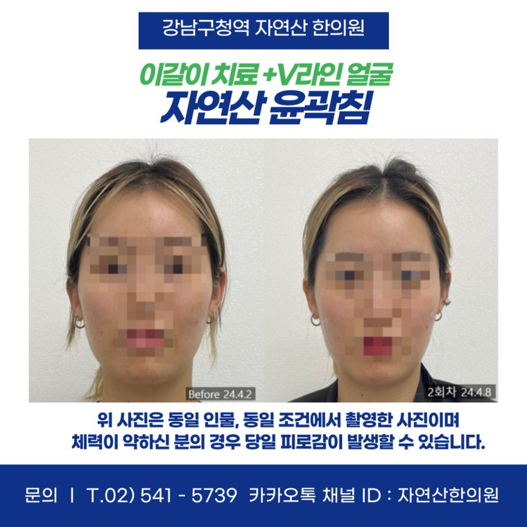 sleep-bruxism-treatment 치료 사례 1 — 시술 전후 비교