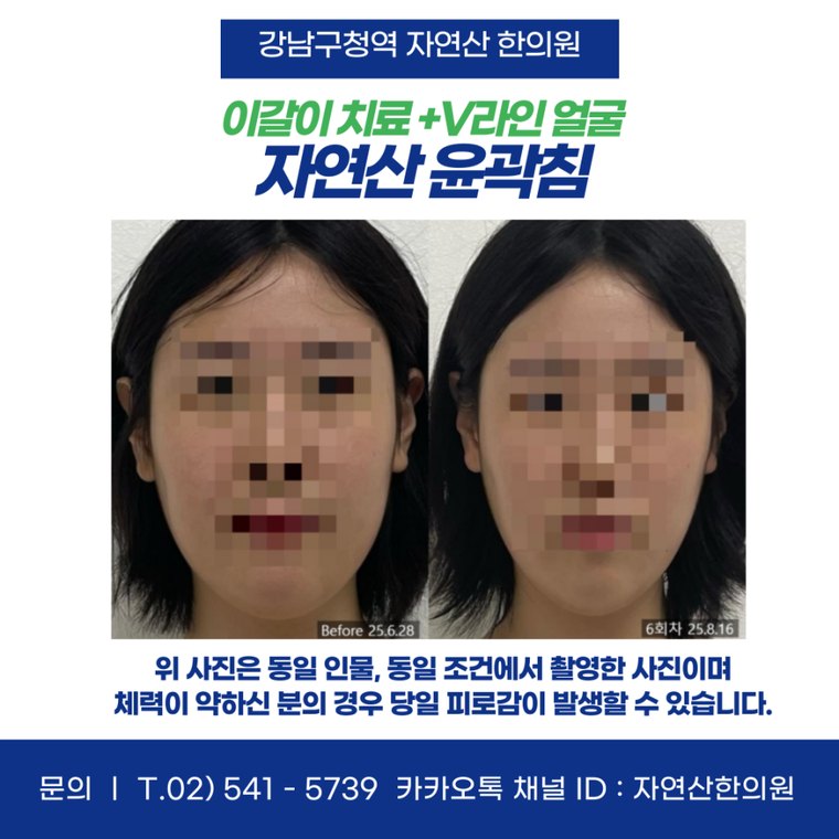 sleep-bruxism-treatment 치료 사례 2 — 시술 전후 비교