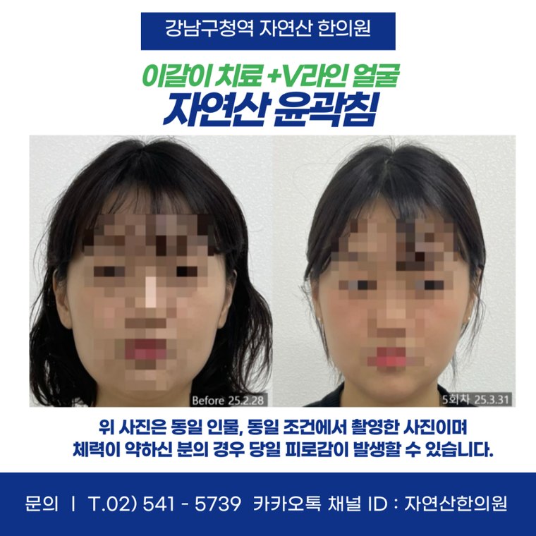 sleep-bruxism-treatment 치료 사례 3 — 시술 전후 비교