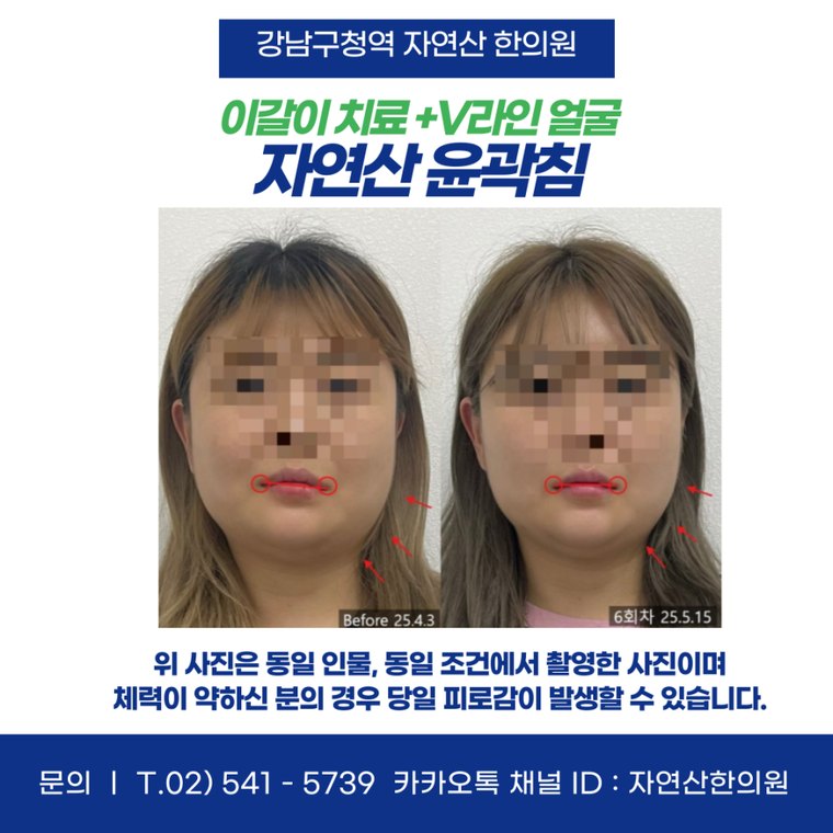 sleep-bruxism-treatment 치료 사례 4 — 시술 전후 비교
