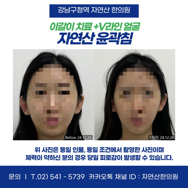 sleep-bruxism-treatment 치료 사례 5 — 시술 전후 비교