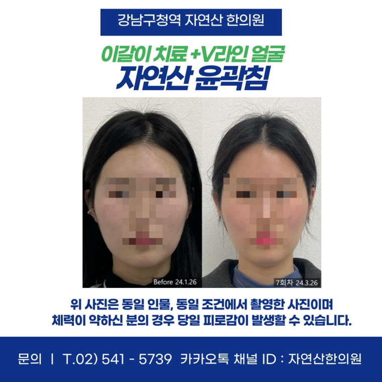 sleep-bruxism-treatment 치료 사례 6 — 시술 전후 비교