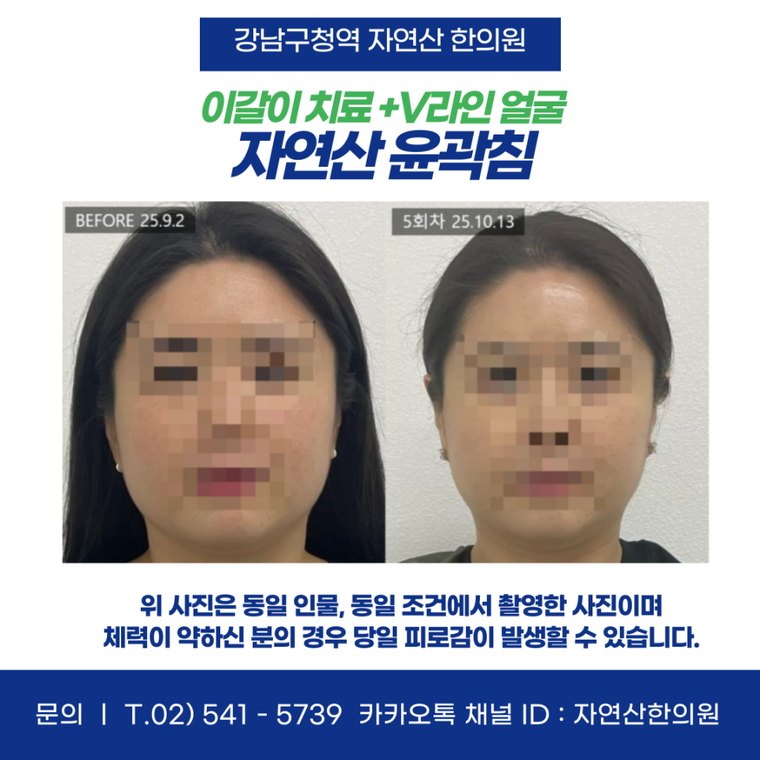 sleep-bruxism-treatment 치료 사례 7 — 시술 전후 비교
