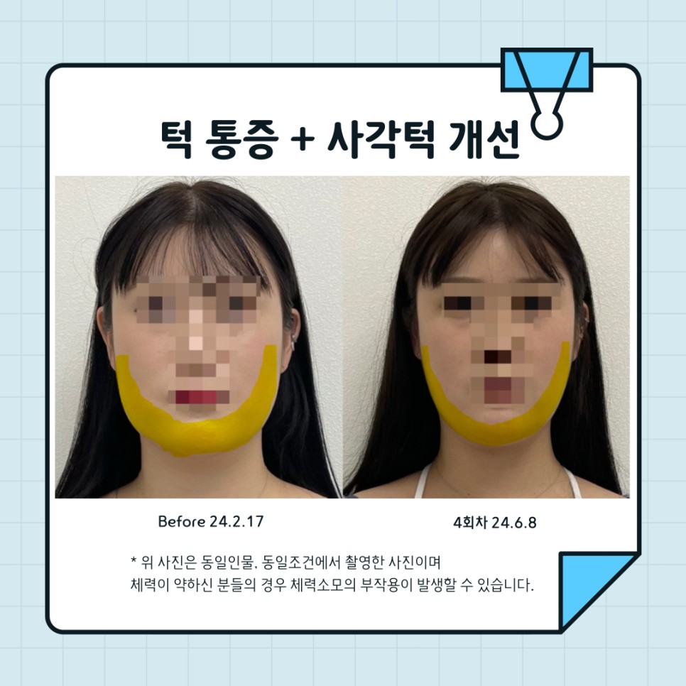 턱근육 시술 기록 8 — 동일 인물·동일 조건에서 촬영한 보정 없는 원본 사진