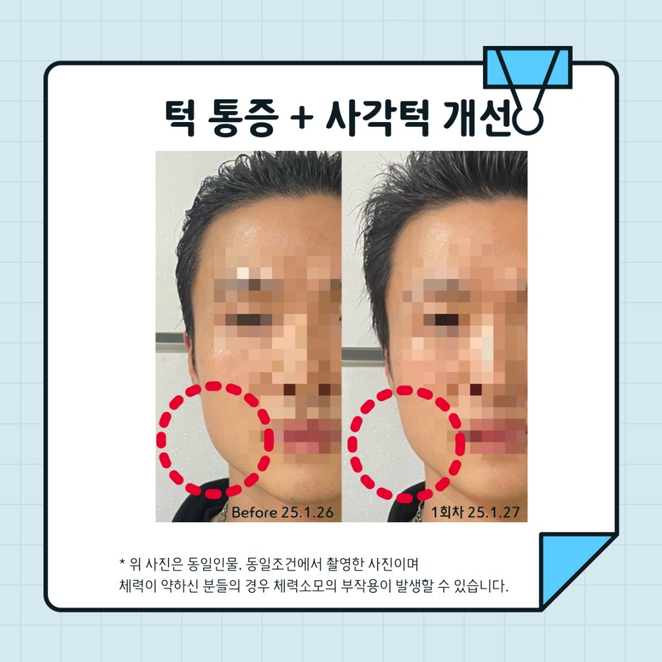 턱근육 시술 기록 9 — 동일 인물·동일 조건에서 촬영한 보정 없는 원본 사진