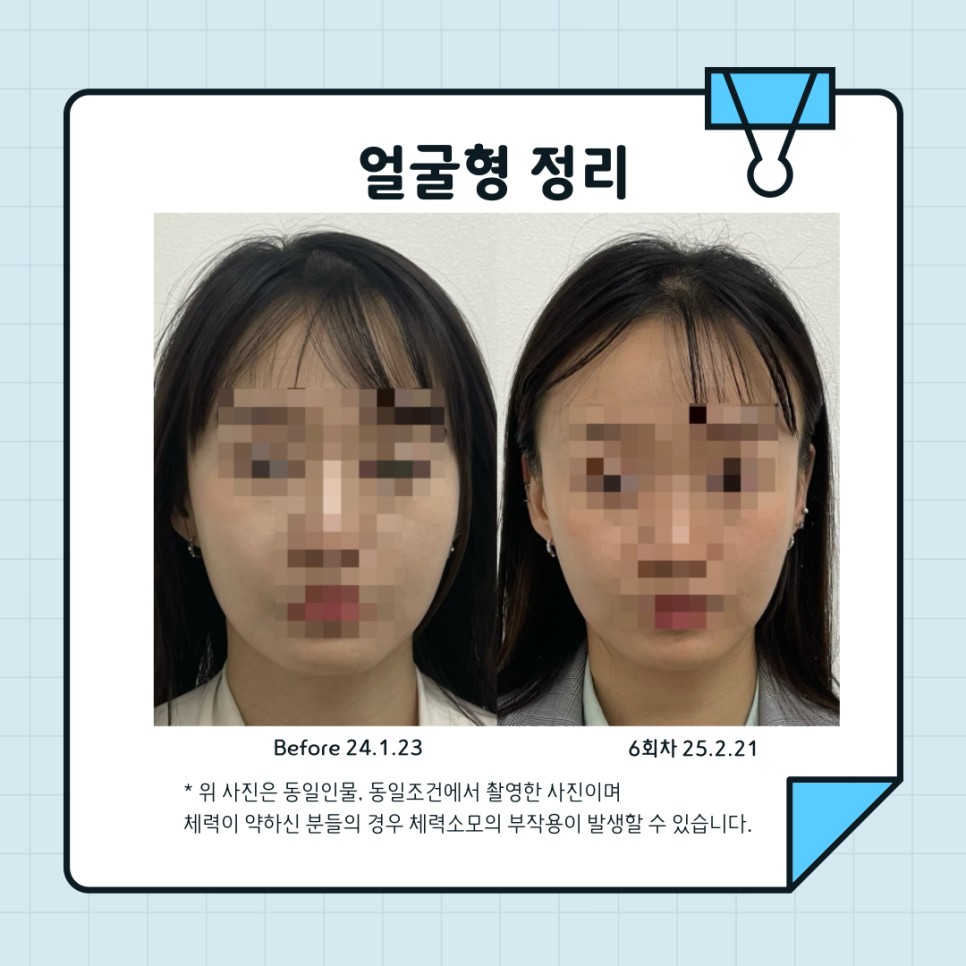 턱근육 시술 기록 10 — 동일 인물·동일 조건에서 촬영한 보정 없는 원본 사진
