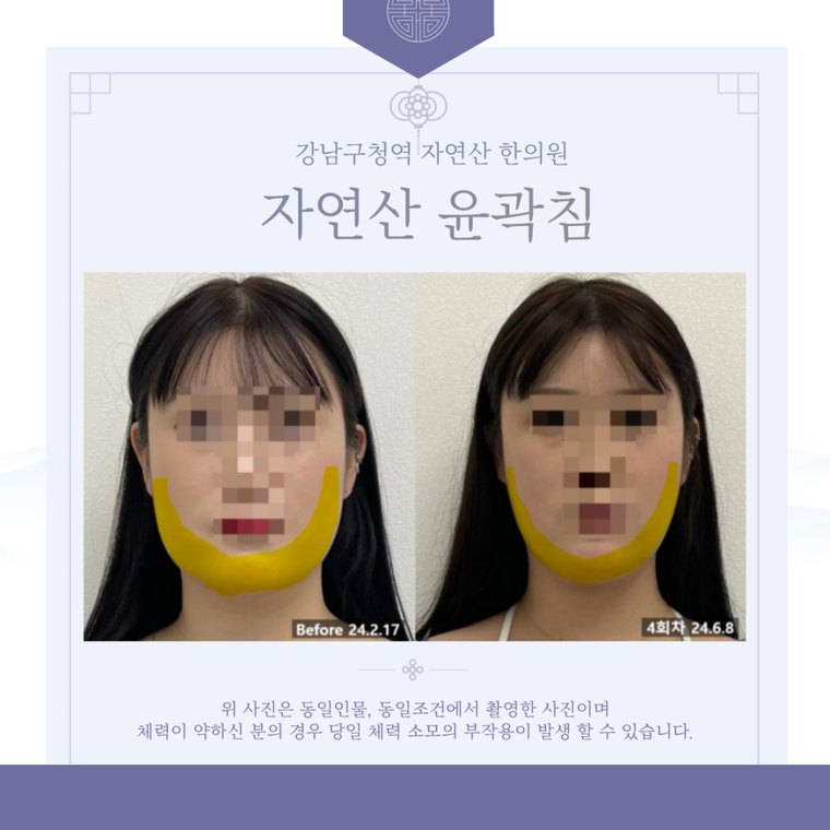 teeth-clenching-habit 치료 사례 1 — 시술 전후 비교