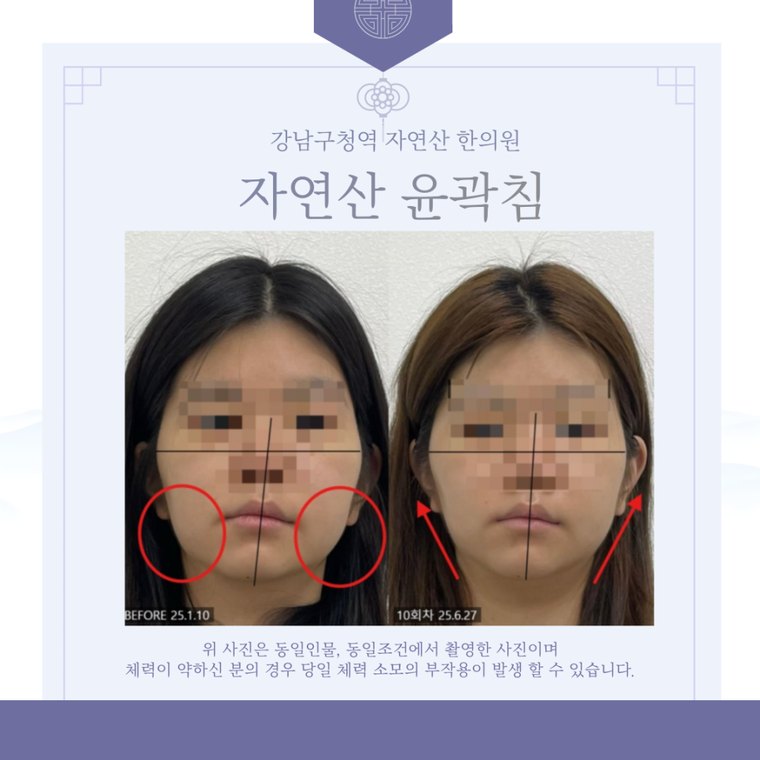 teeth-clenching-habit 치료 사례 2 — 시술 전후 비교