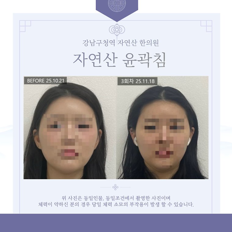 teeth-clenching-habit 치료 사례 3 — 시술 전후 비교