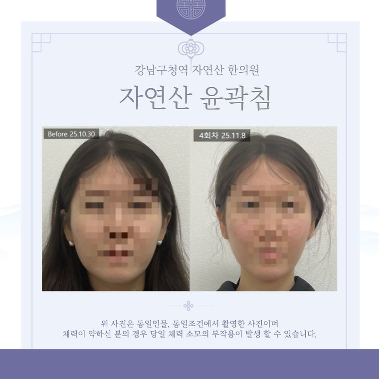 teeth-clenching-habit 치료 사례 4 — 시술 전후 비교