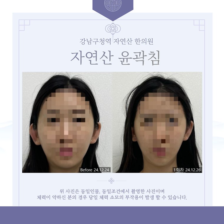 teeth-clenching-habit 치료 사례 5 — 시술 전후 비교