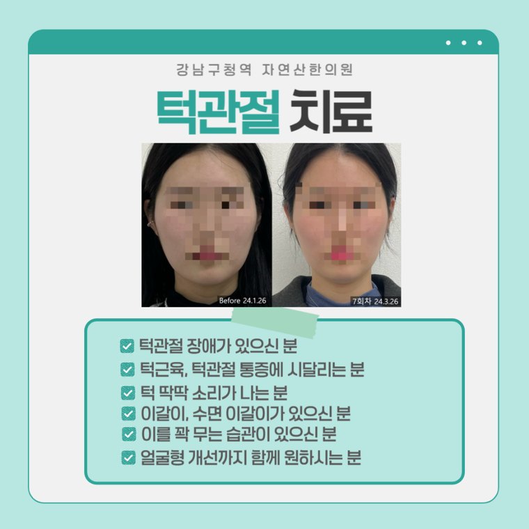 턱관절 치료 사례 — 시술 전과 7회차 비교